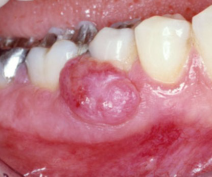 牙龈瘤一般能活几年