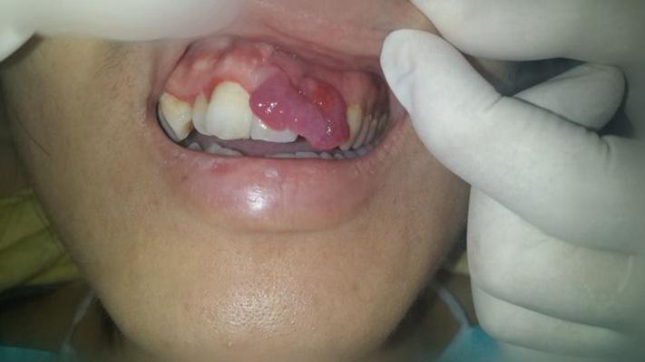 牙龈瘤初期照片